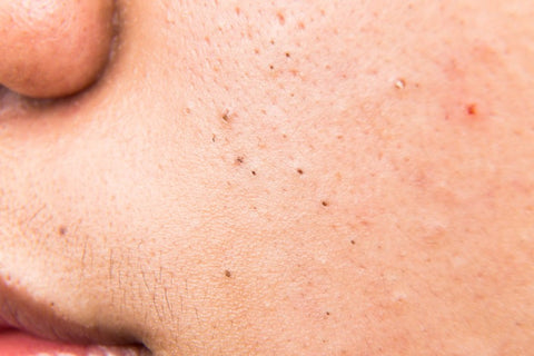 image of face with clogged pores