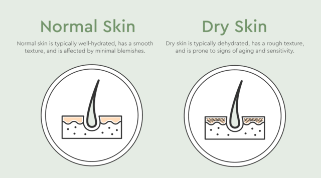 does dry skin cause acne
