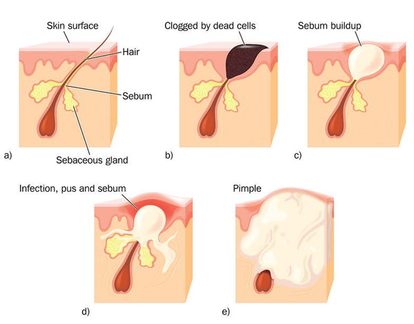 diagram of acne - whiteheads and blackheads