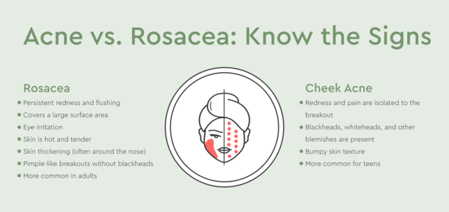 do I have cheek acne or rosacea 