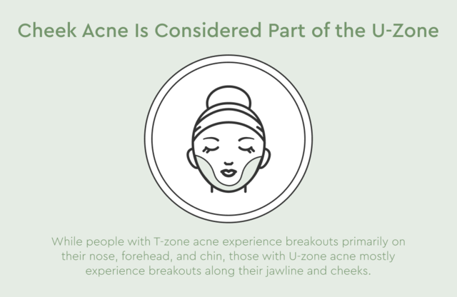 how to get rid of cheek acne - U Zone
