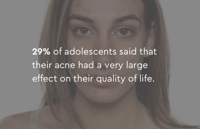 29% of adolescents said their acne had a large effect on their quality of life