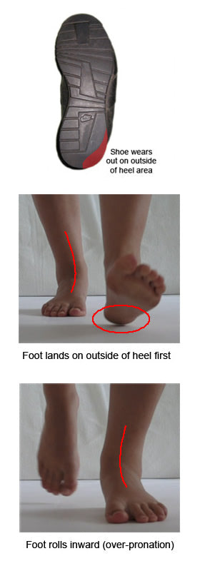 pronation of foot shoes