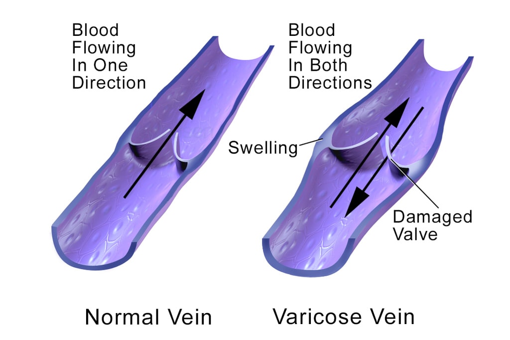 Are Varicose Veins