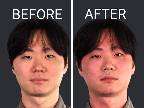 Asian Glow before and after alcohol intolerance
