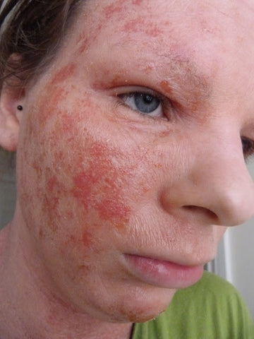 Eczema flare up on Jenny's Face