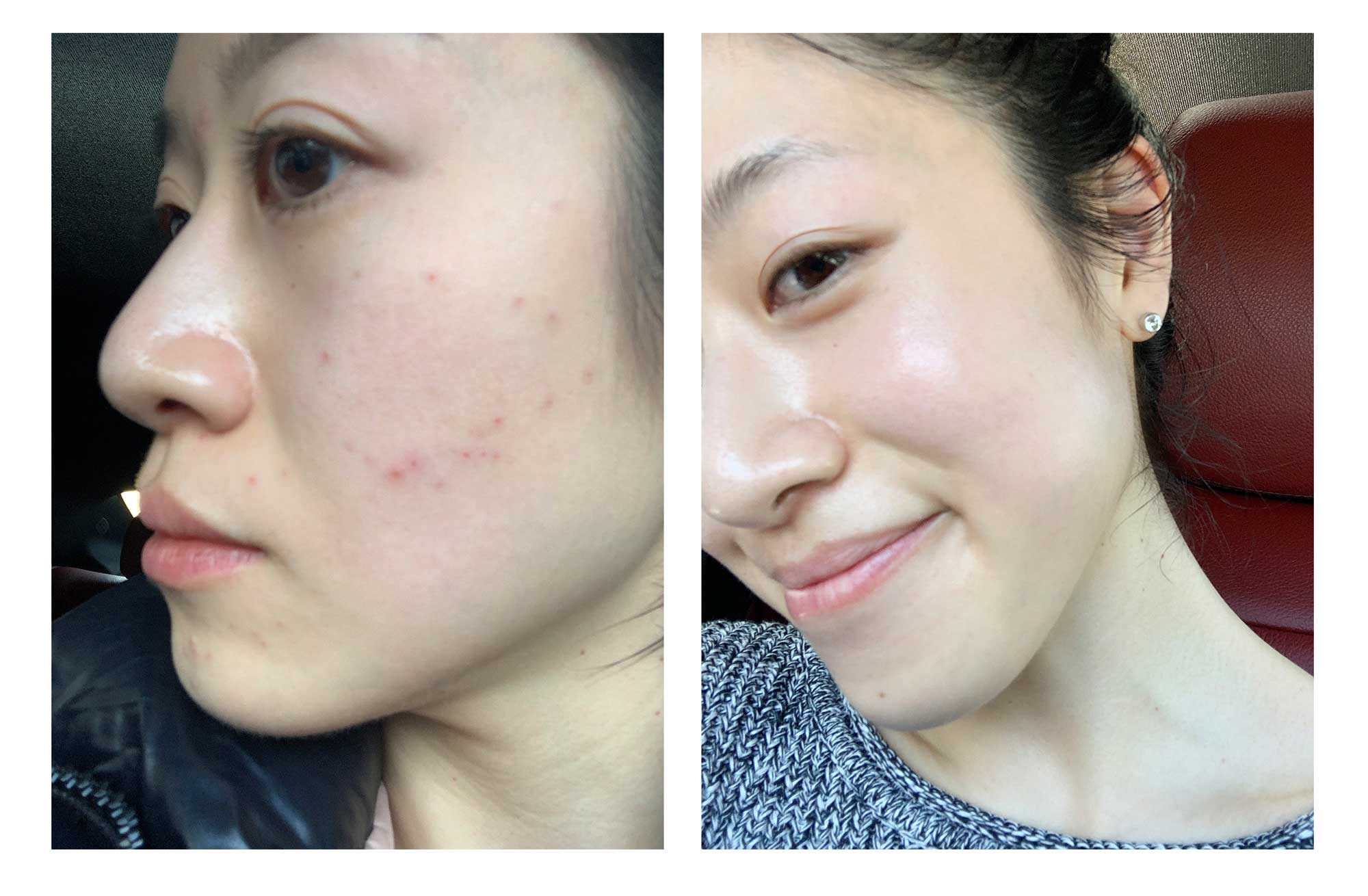 Nicole's results after using MIRA