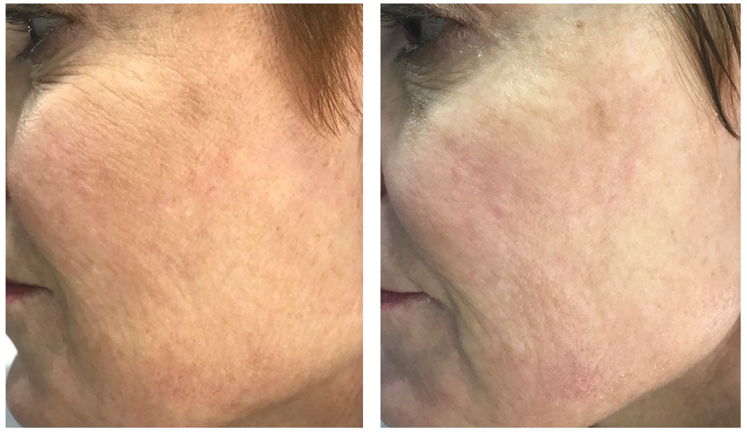 Before / After results showing reduced appearance of fine lines under eye, improved skin texture, and increased moisture 