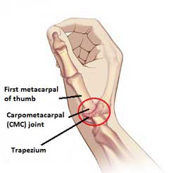 Carpometacarpal CMC joint pain helped with Active650 Thumb Support