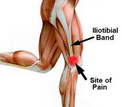 Iliotibial band ITB syndrome pain relief with Active650 