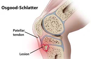Osgood Schlatter Disease pain relief with Active650 Patella Support