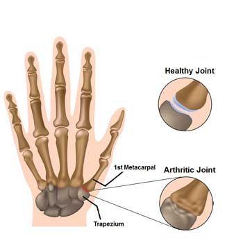 Arthritis pain in thumb