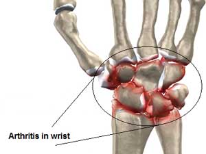 Wrist arthritis pain and sore wrists