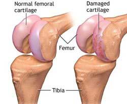 Knee cartilage damage and injury
