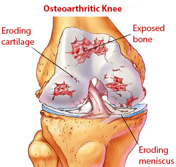 Iliotibial Band Syndrome - Active650