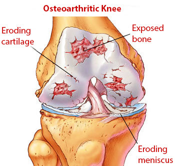 Arthritis in the knee pain relief