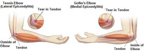 Elbow pain, golfers elbow and tennis elbow