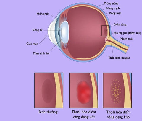 bệnh thoái hóa điểm vàng do lão hóa