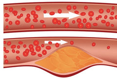 Cholesterol máu cao