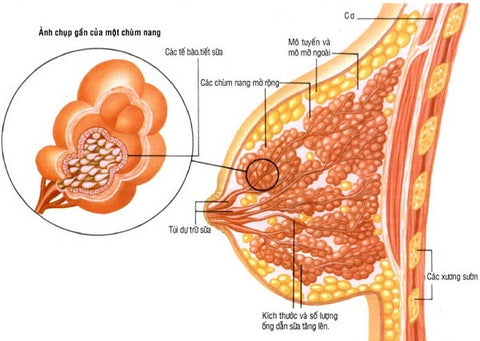 dị sản nang là gì