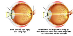 dấu hiệu mắt lão thị