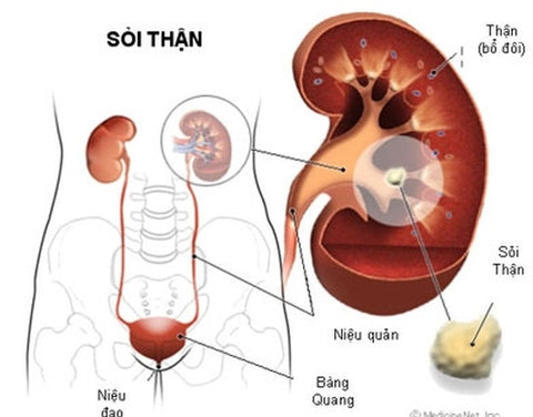 tự chữa sỏi thận và tác hại 