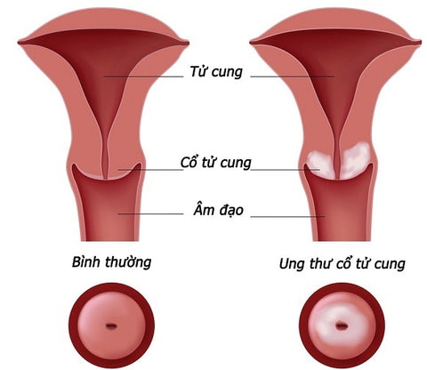 ung thư cổ tử cung