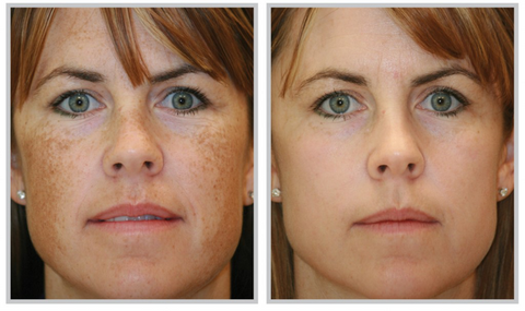 Melasma Removal Picture