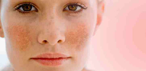 Freckles and Birthmark on Face