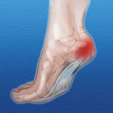 location of fat pad atrophy of the heel