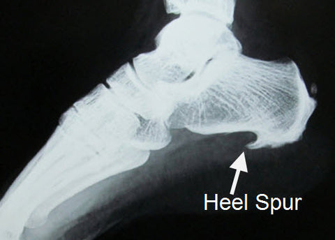 Heel Spur