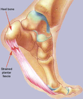 Shows the plantar fascia that will be strained