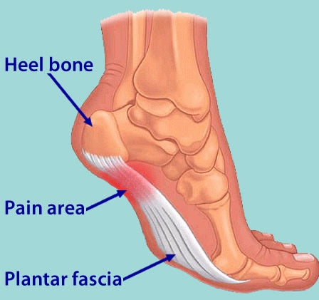 This image shows where abouts on the foot you will experience the pain