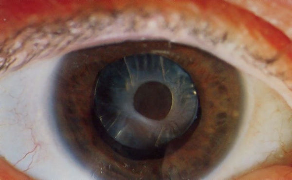 Cataract Eye