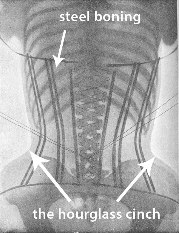 corset xray