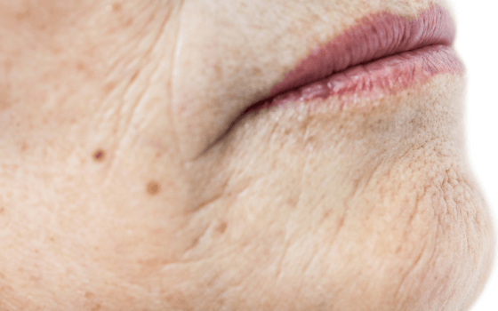 Collagen solution for wrinkles and sagging skin
