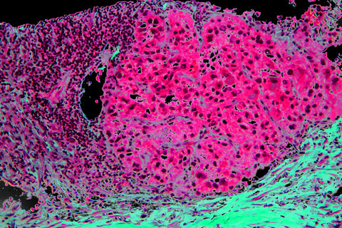liver cancer cell image