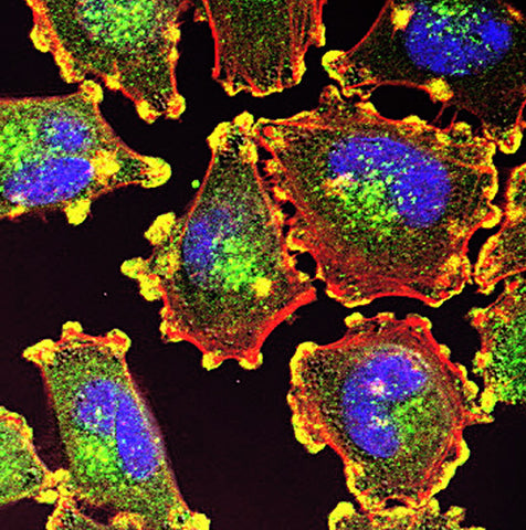 melanoma cell image skin cancer cell image