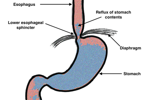  Reflux of Stomach Contents, Gastroeophageal reflux,