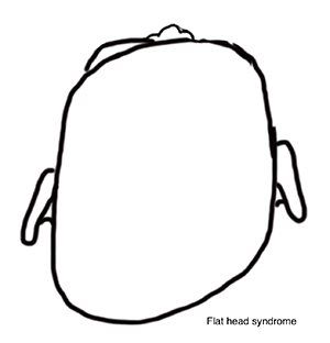 Flat Head syndrome