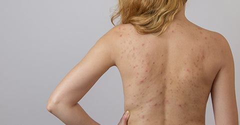 back acne and what to do about it