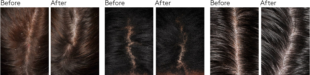 dandruff study before and after