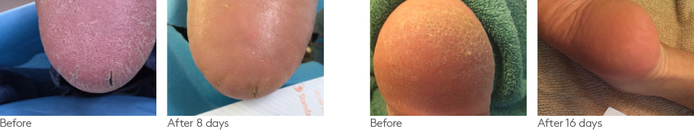 Foot gel clinical study before after