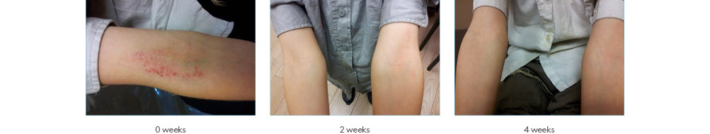 forte cream dermatitis before afters