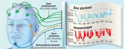 polysomnographie intérpretation