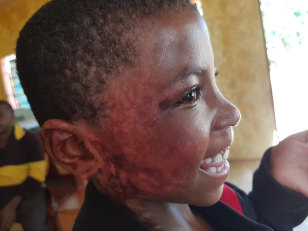 Child burn survivor with scar.