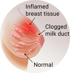mastitis save breastmilk stop wasting breastmilk lactation consultant aLoo myaloo.com aarti mehta MD