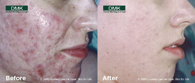 Acne Before After