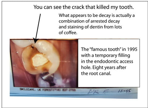 intraoral tooth photo 