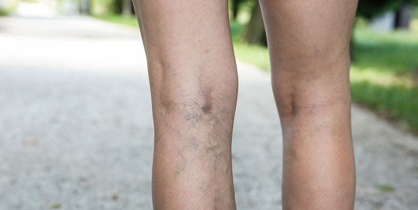 back of legs with varicose veins